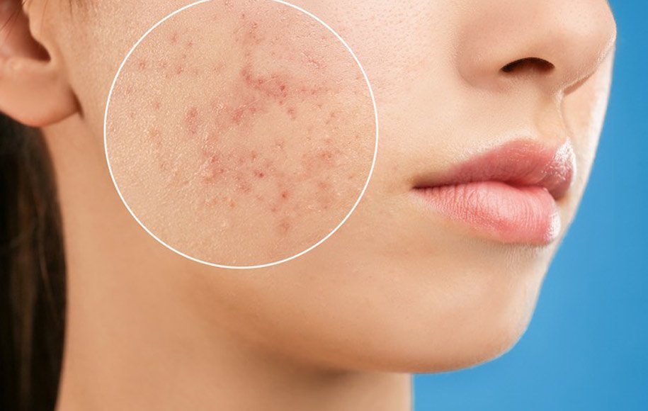 What is salicylic acid and what impact does it have on improving acne and skin health?