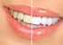 Bright White Smiles Wholesale Teeth Whitening Refill Gel Kit (4) 10cc Syringes 44% Carbamide Peroxide Bleaching Product...