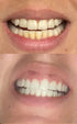 Dr Song Teeth Whitening Gel Refill 4X Syringes 35% Carbamide Peroxide...