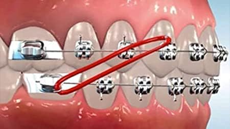 SmileSupplies Orthodontic Intraoral Latex Elastics Tooth Colours Pack of 100 Pcs + Free Placer for Braces (1/4" - 4.5 Oz)...