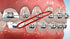 SmileSupplies Orthodontic Intraoral Latex Elastics Tooth Colours Pack of 100 Pcs + Free Placer for Braces (1/4" - 4.5 Oz)...