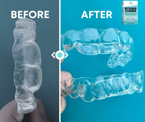 Retainer Cleaner, Denture Cleaner (120 Tablets) Removes Cloudiness, Brightens and Freshens Clear Aligners, Retainers, Night Guards, Mouth Guards, ...
