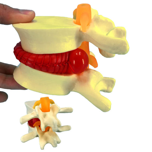 Human Anatomical Lumbar Disc Herniation Model, 1.5 Times Life Size Lumbar Disc Herniation Model, Human Lumbar Disc Herniation Model for Teaching, ...
