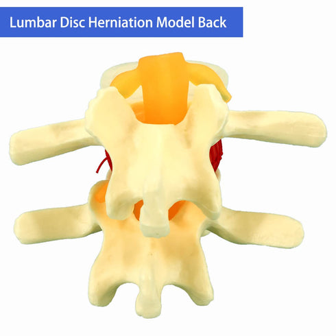 Human Anatomical Lumbar Disc Herniation Model, 1.5 Times Life Size Lumbar Disc Herniation Model, Human Lumbar Disc Herniation Model for Teaching, ...