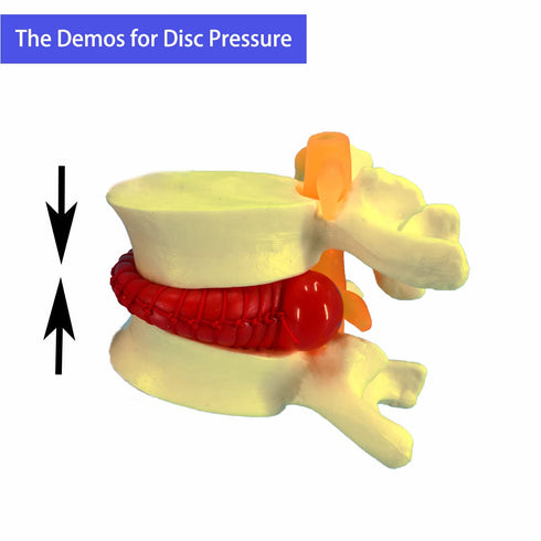 Human Anatomical Lumbar Disc Herniation Model, 1.5 Times Life Size Lumbar Disc Herniation Model, Human Lumbar Disc Herniation Model for Teaching, ...