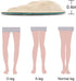 Dr. Foot's Supination & Over-Pronation Corrective Shoe Inserts, Medial & Lateral Heel Wedge Insoles for Foot Alignment, Knee Pain, Bow Legs, Osteo...