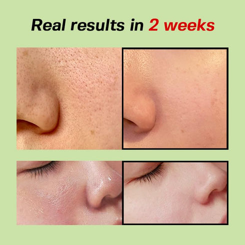 Green Tomato Pore Lifting Ampoule + | Instant Pore Minimizing & Tightening Facial Serum for Enlarged and Saggy Pores | Korean Skincare | 1.01 Fl O...