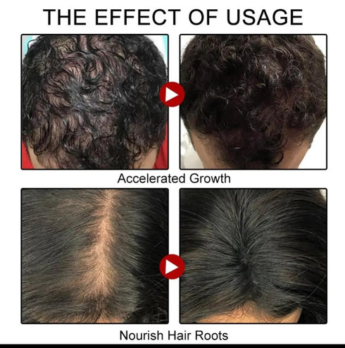 Ginger Hair Growth Spray. Promotes Thicker Longer Hair. Ginger Extract Prevents Baldness, and Moisturizes the Scalp. Promotes Hair regrowth, stren...