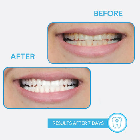 GO SMILE On The Go Teeth Whitening Pen, Teeth Whitener & Stain Remover Self Care Gifts for Women & Men - Whitening Strips Alternative - Travel Siz...