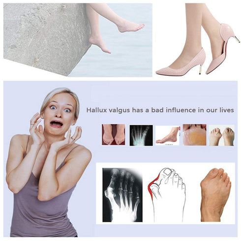 Bunion Corrector, Bunion Splints and Bunion Relief for Hallux Valgus, Big Toe Joint,Adjustable Bunion Splint Protector Sleeves kit F or Women and ...