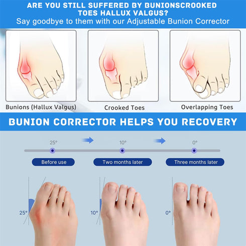 Bunion Corrector Women Men Big Toe, Adjustable Orthopedic Bunion Splint 2 Pcs Bunion Pads for Hallux Valgus Pain Relief Non-Slip Toe Straightener...