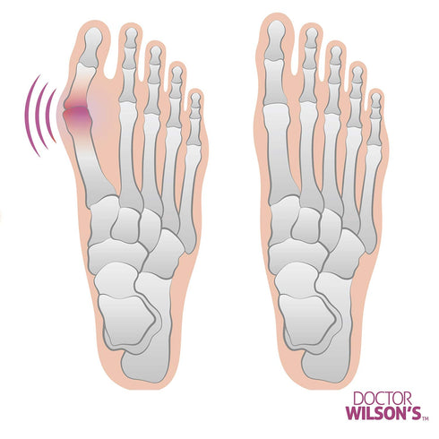 2 Bunion Relief Pads Sleeve - Bunion Splint Orthopedic Bunion Corrector Socks - Gel Pad Elastic Cushions Men and Women (1 Pair)...
