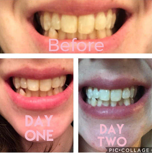 Dr Song Teeth Whitening Gel Refill 4X Syringes 35% Carbamide Peroxide...