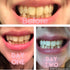 Dr Song Teeth Whitening Gel Refill 4X Syringes 35% Carbamide Peroxide...