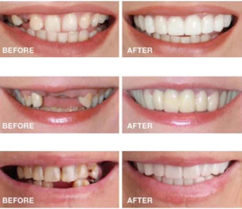 2 Pairs,Men's and Women's Temporary Cosmetic Confident Smile...