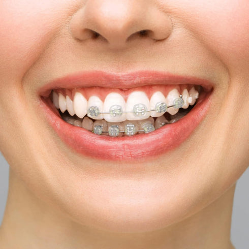 BVN Braces Wax Dental Wax: 20 Boxes Orthodontic Wax Strips, Braces Wax for Teeth, Ortho Wax for Braces, Tooth Wax, Mouth Wax, Oral Wax for Braces,...