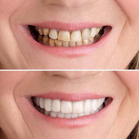 2 Pairs,Men's and Women's Temporary Cosmetic Confident Smile...