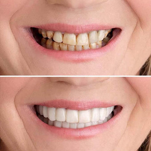 Men's and Women's Temporary Cosmetic Confident Smile...