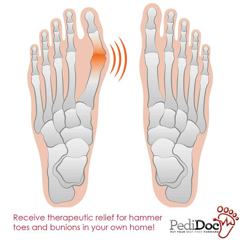 Bunion Corrector Bunion Toe Straightener – Bunion Relief Big Toe Strap Bunion Splint Restores Natural Alignment of Overlapping and Crooked Toes – ...