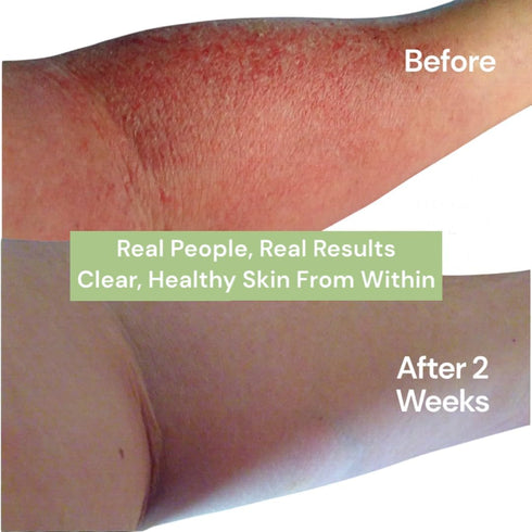 Eczema Pill – Natural Eczema Treatment – Dermatologist Developed – 7 All Natural Minerals Clear & Prevent Eczema Scaling, Rash, Itch, Inflamed Ski...