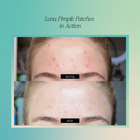 Good Light Luna Pimple Patches. Fast-Acting, Non-Drying, and Vegan Hydrocolloid Patches to Shrink Blemishes in Just a Few Hours. 10mm and 12mm Pat...