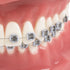 TM-208 Demonstration Orthodontic Model Teeth Teach Study Tools with Metal and Ceramic Bracket(Red)...