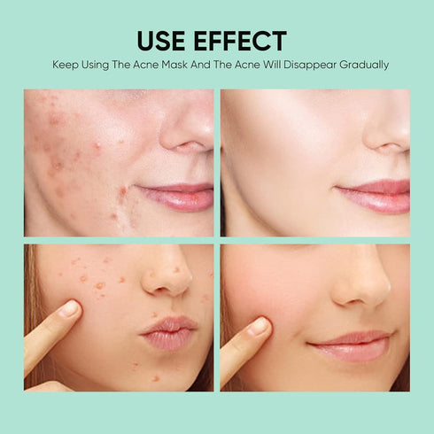Anti Acne Face Mask Skincare, Salicylic Acid Acne Treatment Sheet Mask, Acne Facial Mask for Acne Prone Skin, Oil Control, Deep Cleansing Face Mas...