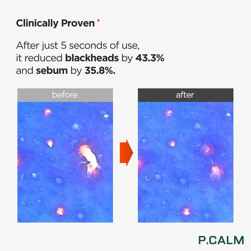 P.CALM UnderPore Holy Basil Cleansing Oil 6.42 fl.oz | Instant Blackhead Reducing Non-Comedogenic Pore Control Cleansing Oil with Holy Basil Extra...
