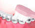2 Pieces Tuft Toothbrush Small Head End Tapered Wisdom Interdental Interspace Nursing Soft Tiny Toothbrush Orthodontic Gum Periodontal Dental Prod...