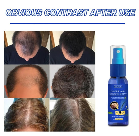Ginger Hair Growth Spray. Promotes Thicker Longer Hair. Ginger Extract Prevents Baldness, and Moisturizes the Scalp. Promotes Hair regrowth, stren...