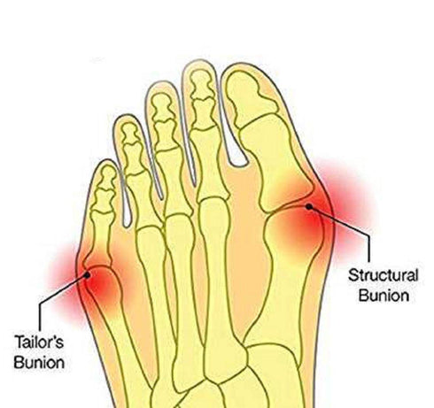 CYG&CL Bunion Corrector and Bunion Pain Relief Sleeves Toe Protector with Gel Toe Spacers, Built-in Soft Silicone Pads for Big Toe Straighten, Hal...