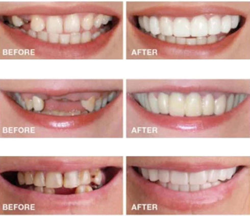 Men's and Women's Temporary Cosmetic Confident Smile...