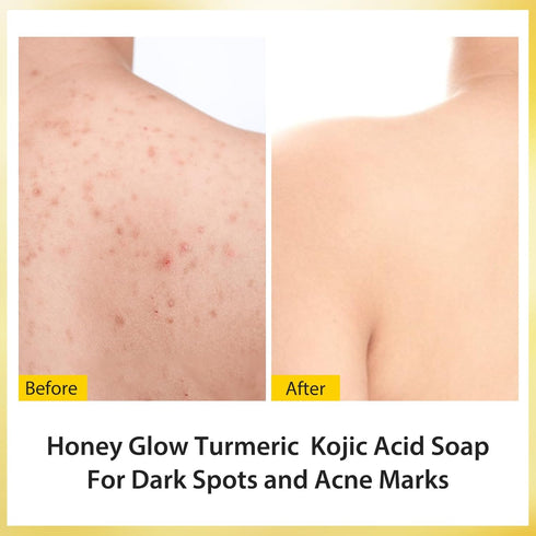 Tamoskiny Honey Glow Lemon Turmeric Kojic Acid Soap Bar for Hyperpigmentation, Lemon Turmeric Kojic Soap for Dark Spots Remover, Deep Cleansing Fa...
