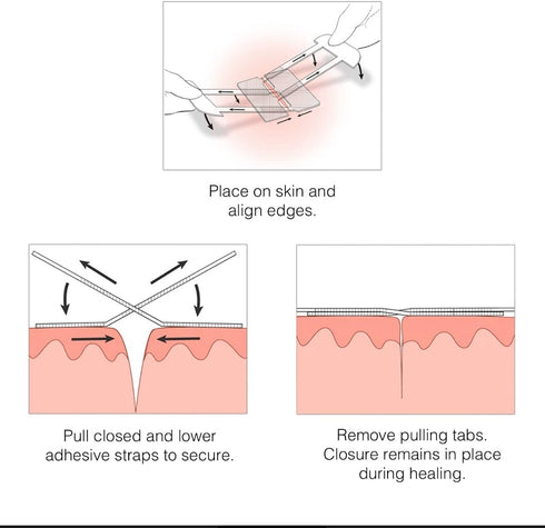 Clozex Emergency Laceration Kit - Repair Wounds Without Stitches. FDA Cleared Skin Closure Device for a Wound Up to 1 1/2 Inches in Length. Comple...