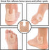 48 Pieces U Shaped Felt Callus Pads Metatarsal Pads Forefoot Foot Pads Pain Relief Foot Cushion Keep Protecting Calluses from Rubbing on Shoes Adh...