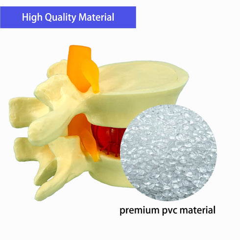 Human Anatomical Lumbar Disc Herniation Model, 1.5 Times Life Size Lumbar Disc Herniation Model, Human Lumbar Disc Herniation Model for Teaching, ...