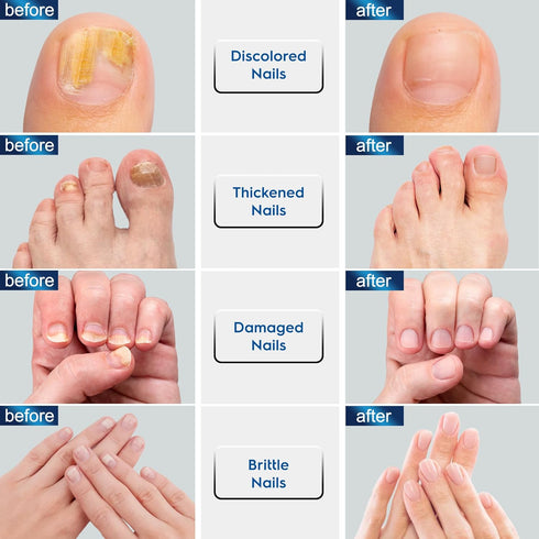 Toenail Fungus Treatment Extra Strength, Fungus Treatment for Toenails and Fingernails with Natural Oils, Toe Nail Fungus Treatment for Men and Wo...