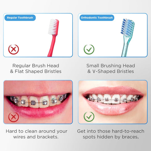 V-Shaped Orthodontic Toothbrush for Braces, Soft Bristles, 6 Count, No Interdental Brushes Included...