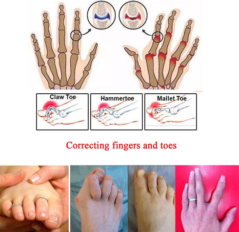 8 Pieces Toe Splint Wraps Non Slip Hammer Toe Straightener for Broken Toe, Crooked, Overlapped, and Hammer Toes-Women and Men...