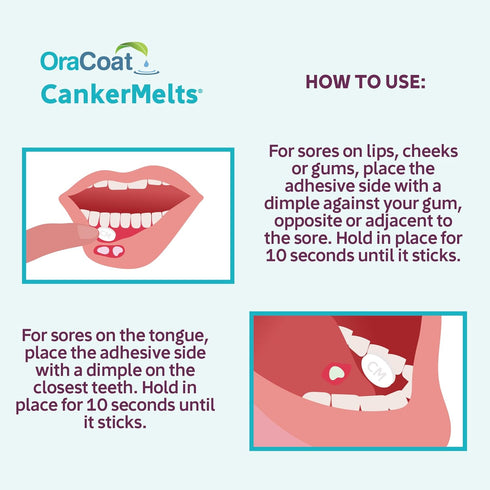 Oracoat® CankerMelts® Stick-On Melts™ Mouth Sore Treatment, 20 Count...