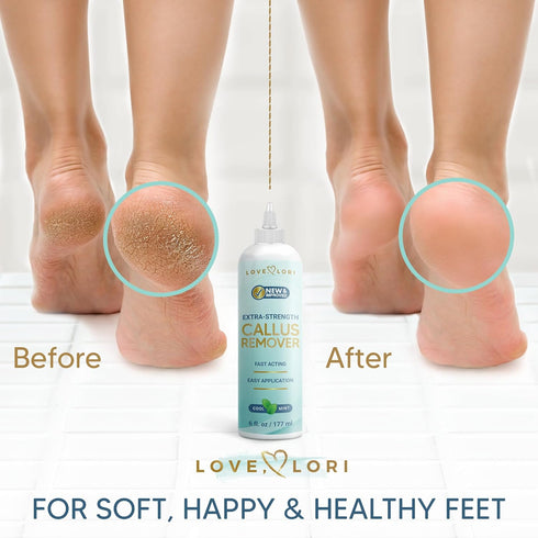 Callus Remover for Feet (Extra Strength) Foot Callus Remover Gel - Feet Scrubber, Pedicure Spa Tools, 6oz...