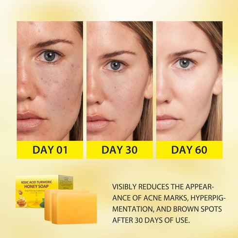 Tamoskiny Honey Glow Lemon Turmeric Kojic Acid Soap Bar for Hyperpigmentation, Lemon Turmeric Kojic Soap for Dark Spots Remover, Deep Cleansing Fa...