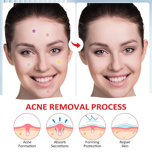 280 Counts Acne Patches for Face,Hydrocolloid Pimple Patches with Salicylic Acid,Tea Tree Oil and Centella Extract,Cute Star Zit Cover Patches,Col...