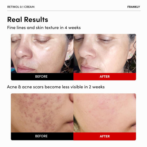 FRANKLY Retinol 0.1 Cream - Beginner Retinol | Anti-Aging, Skin Lifting & Restoration | Acne-Prone Skin | Enriched with Ceramides & Natural Ginsen...