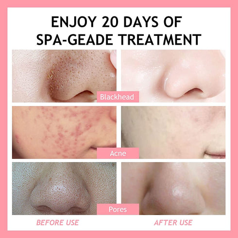 Strawberry Clay Mask for Face, Pink Clay Facial Mask Skin Care Improve Blackheads Acne Dark Spots, Deep Cleansing Face Mask Control Oil and Refini...