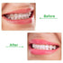 10 Pieces Aligner for Aligner Chompers Aligner Trays Seater Orthodontic Dental aligner(Green)...