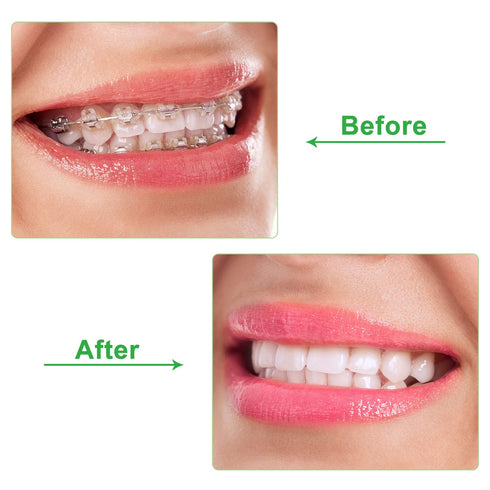 20 Pieces Aligner Tray Seaters for Aligner Trays Chompers Orthodontic Trays(Green)...