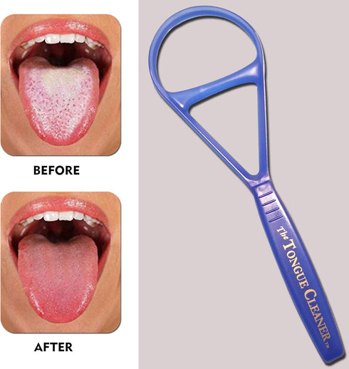 Tongue Scraper Cleaner - the Tongue Cleaner - End Bad Breath and Freshens Breath - Eliminate Bad Breath - Bad Breath Treatment (Color May Vary)...