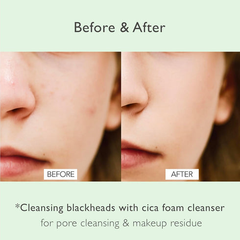 Cica Pore Cleansing Foam | Pore Cleansing and Sebum Control | Cica, Hyaluronic Acid, Aloe | Daily Face Wash | Korean Skin Care for face (4.05 fl.o...