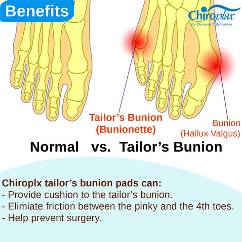 Chiroplax Tailor's Bunion Corrector Pads Bunionette Pain Relief Pinky Little Toe Straightener Separator Cushion Splint Protector Shield Spacer Cov...